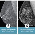 Busting Some Myths About Mammograms