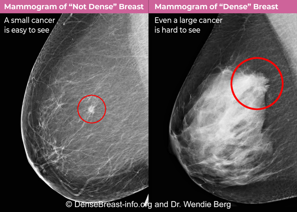 Breast density