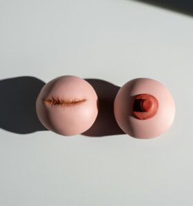 lumpectomy
