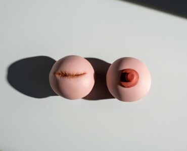 lumpectomy