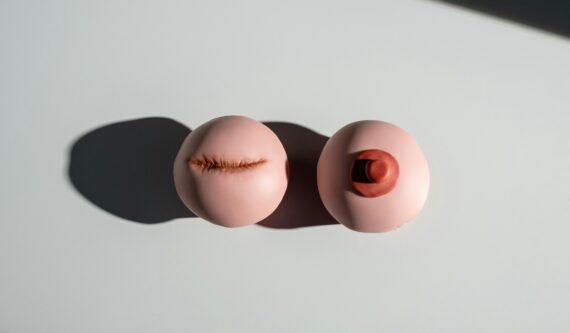 lumpectomy