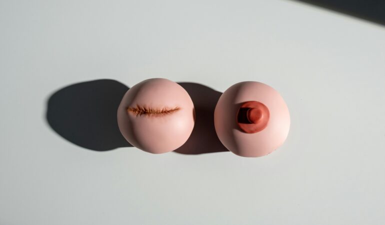 lumpectomy