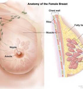 occult breast cancer