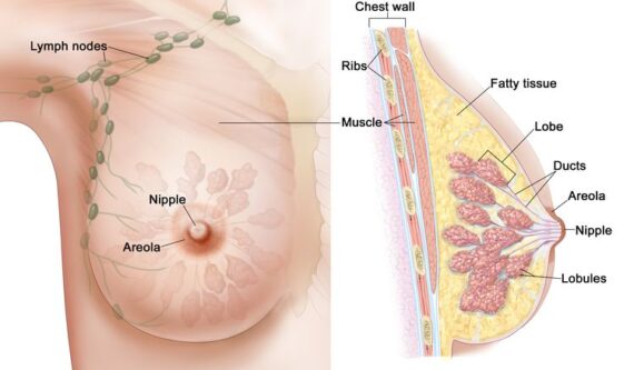 occult breast cancer