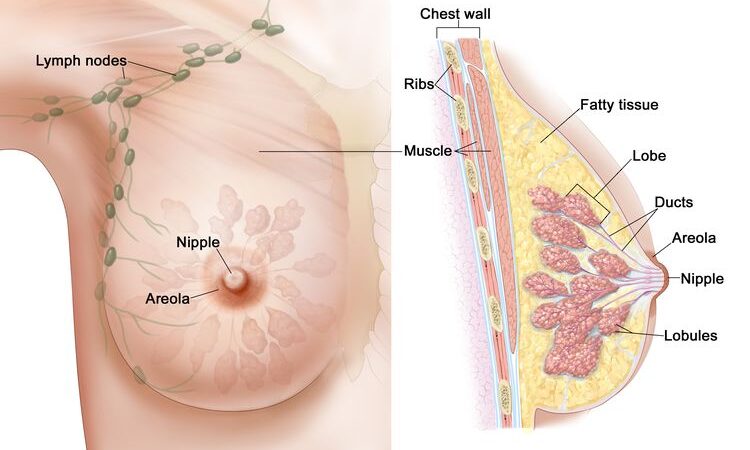 occult breast cancer